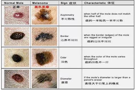 胎痣|哪些胎记要注意？看这一篇就够啦